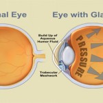 glaucoma_1