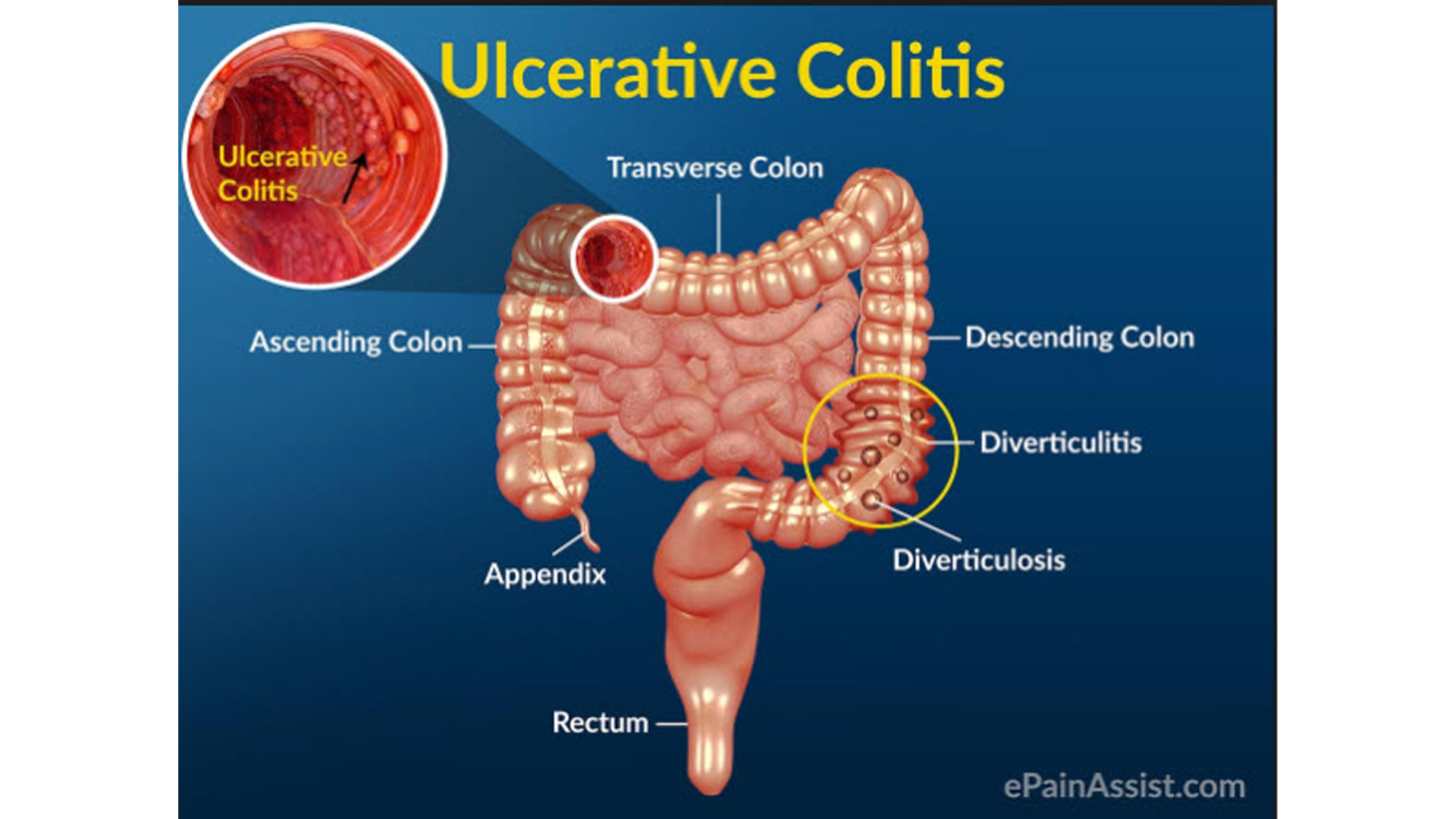 Living with ulcerative colitis... - Good News!
